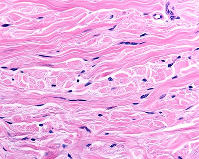 Fibroplast plasma monocrom img3