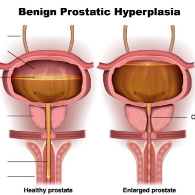 Benign prostatic hyperplasia