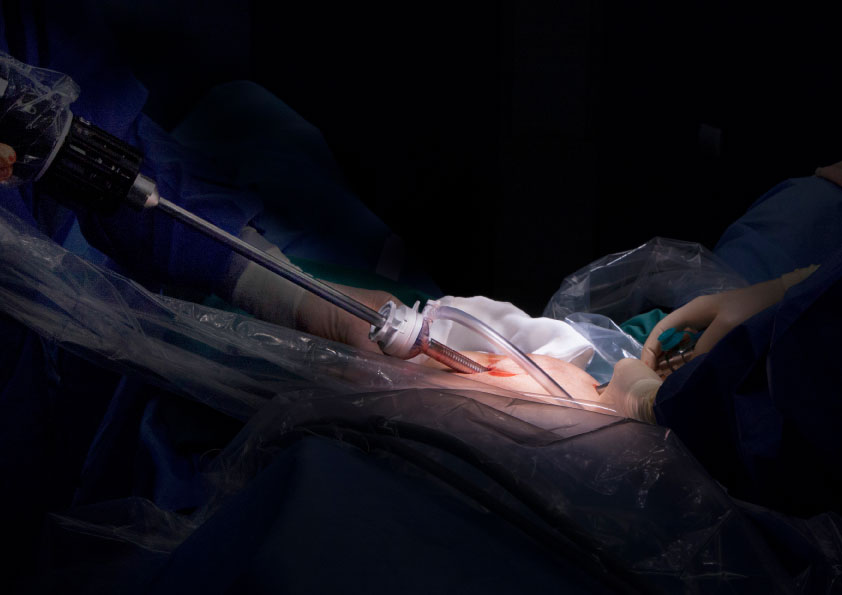 Prostatectomy with laser