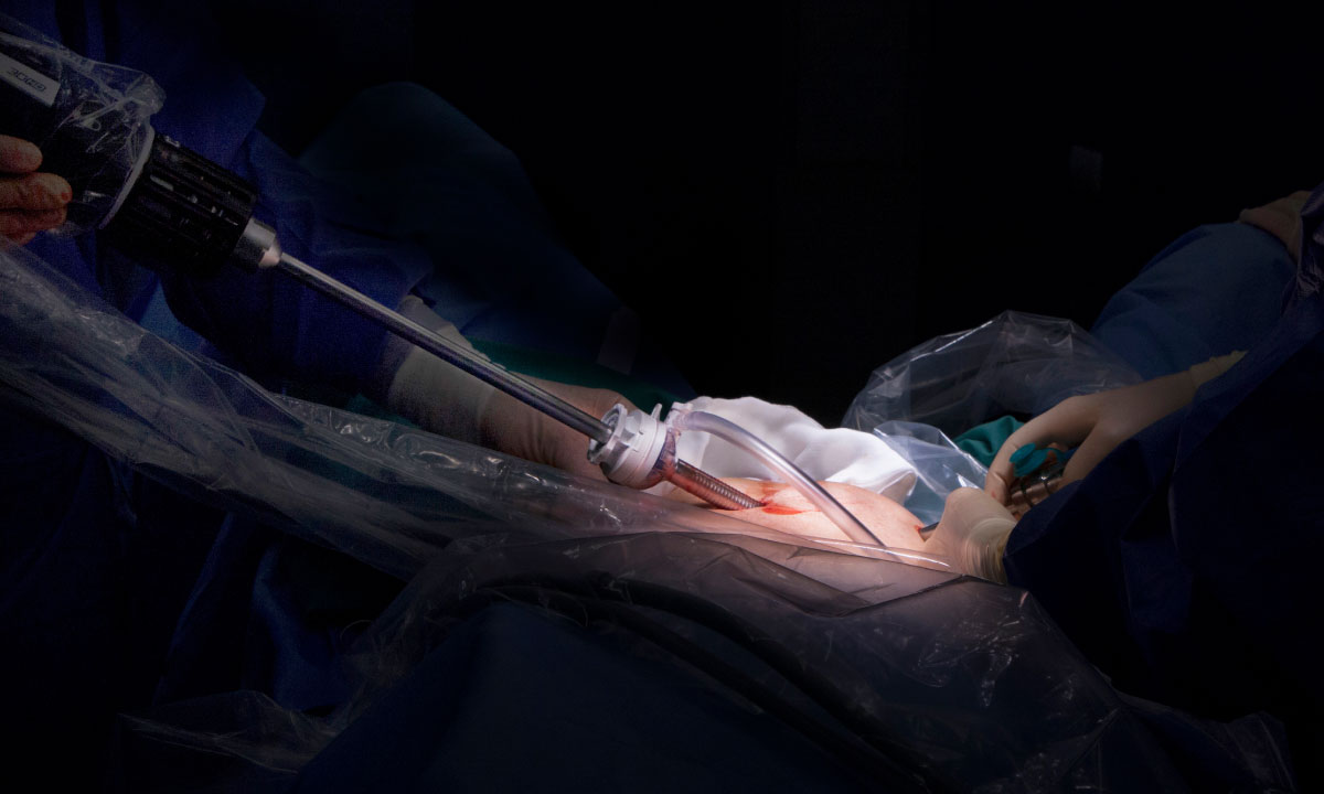 Laser surgery urology
