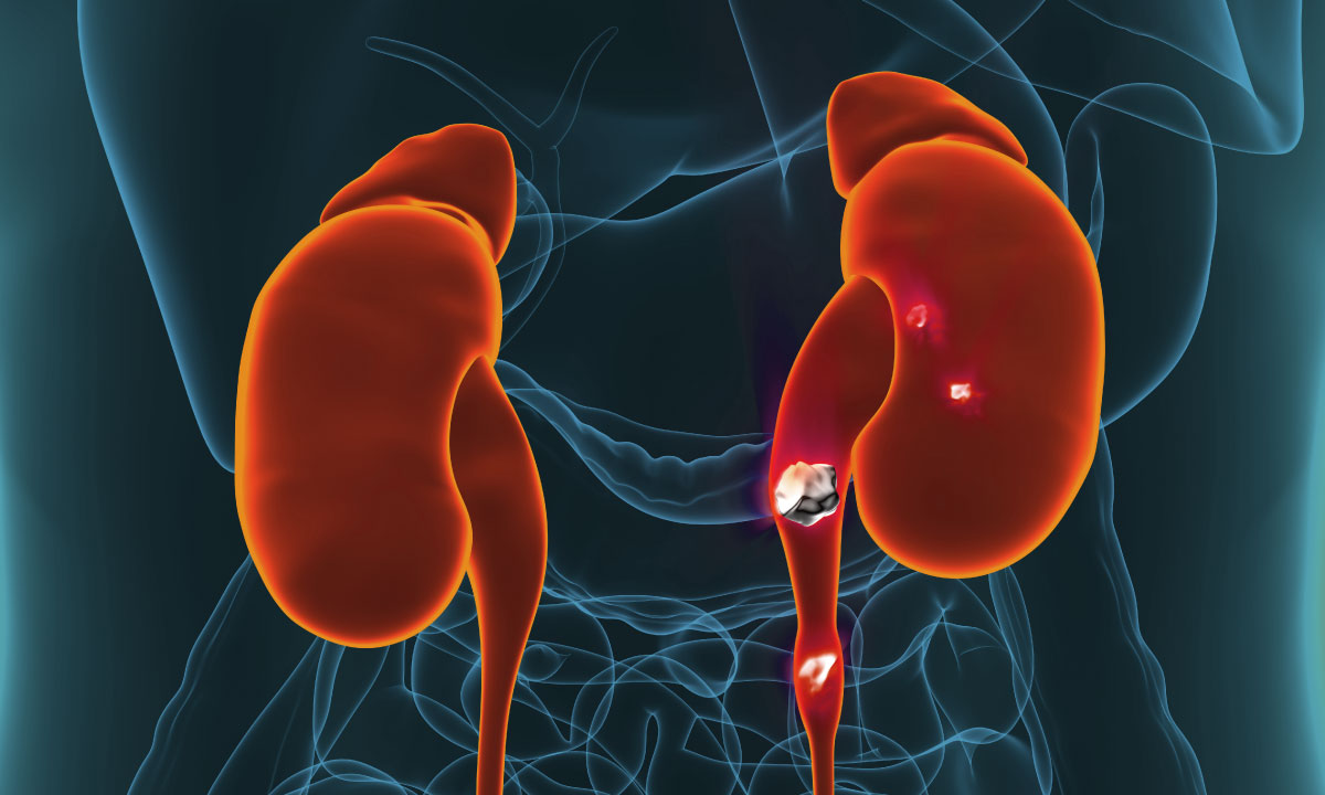 Laser lithotripsy kidney stones